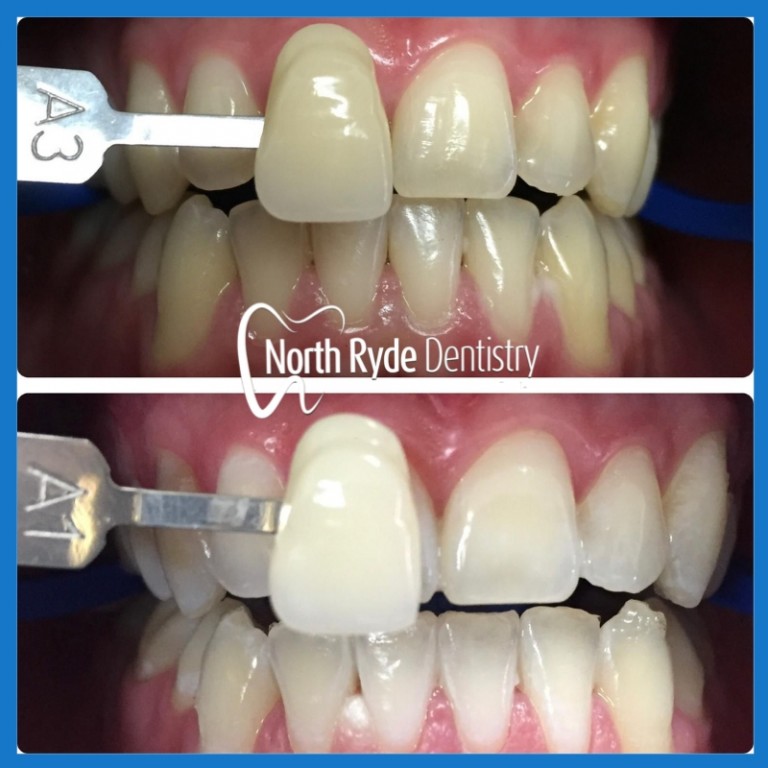 Teeth whitening cost Dentists in North Ryde North Ryde Dentistry