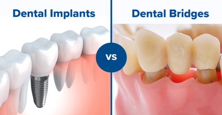 Choosing Between A Bridge And A Tooth Implant Dentists In North Ryde North Ryde Dentistry 