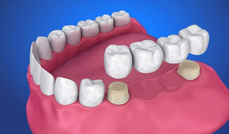 Dental Bridge Cost North Ryde Dentistry   Dental Bridge Cost Sydney 770x453 