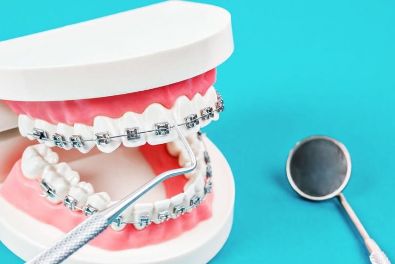 How Much Do Braces Cost? North Ryde Dentistry