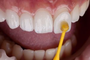 Composite Resin Veneers