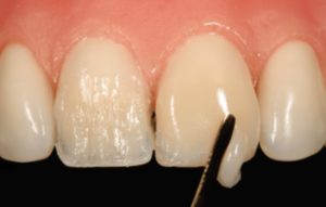 Composite Veneers Cost