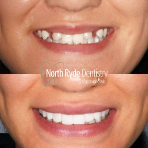 Dental Veneers Before and After