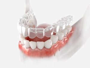 Invisalign Near Me