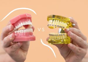 Invisalign vs Braces