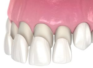 Teeth Veneers Cost